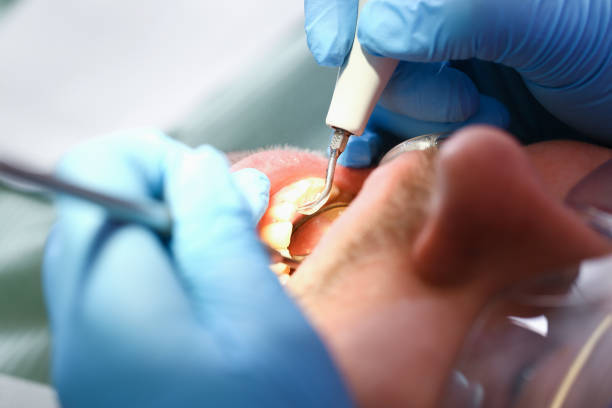 Best Emergency Root Canal Treatment in Pella, IA